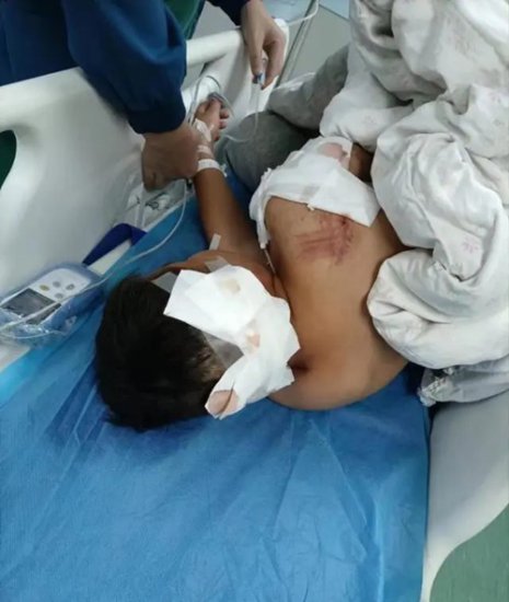10岁男童遭阿拉斯加犬咬伤 事发第三天仍在ICU救治