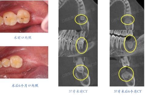 <em>牙周炎导致的</em>缺牙，还能做种植牙吗？