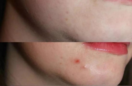 深圳肤康皮肤病专科介绍：<em>嘴巴周围长痘痘是</em>什么原因造成的？