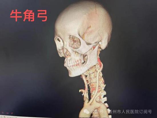 <em>晋州市</em>人民医院外一科完成我市首例经桡动脉入路全脑血管造影术