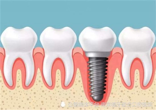 南京<em>种植</em>牙医院：<em>牙齿</em>缺失后牙槽骨会一直萎缩吗？
