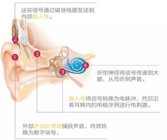 上海市儿童医院疫情期间已开展20例人工耳蜗植入手术