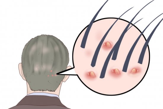头皮上长痘痘<em>是什么原因 是什么</em>导致头皮上长痘痘