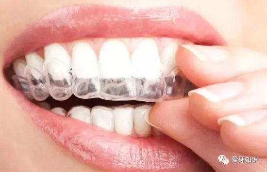 <em>成都</em>牙科医生任欢科普：牙齿矫正如何选择适合的牙套？