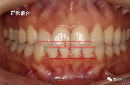 <em>成都</em>牙科医生任欢科普：深覆盖和深覆颌有什么区别和影响？
